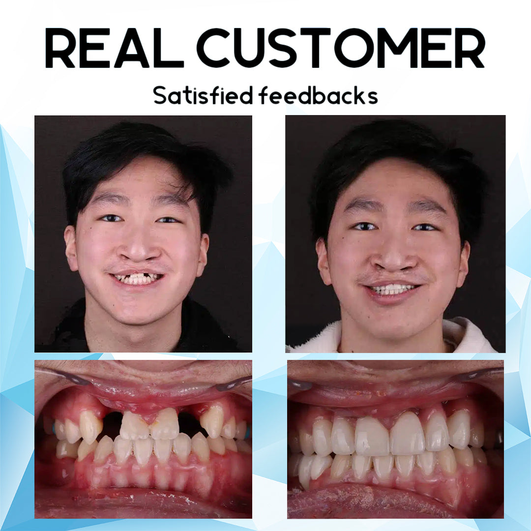 Furzero™ Silicone Reline Denture Set🦷✨